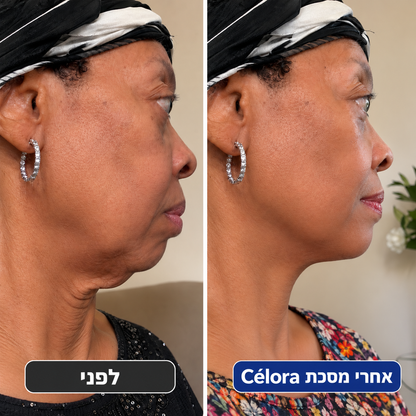 מסכת הרמה למיצוק הסנטר
