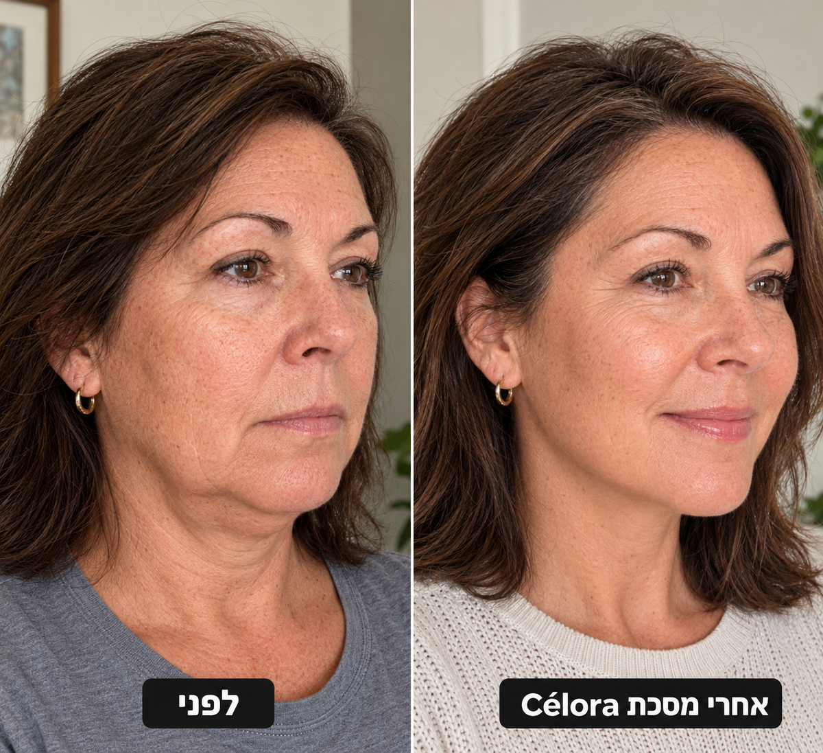 מסכת הרמה למיצוק הסנטר